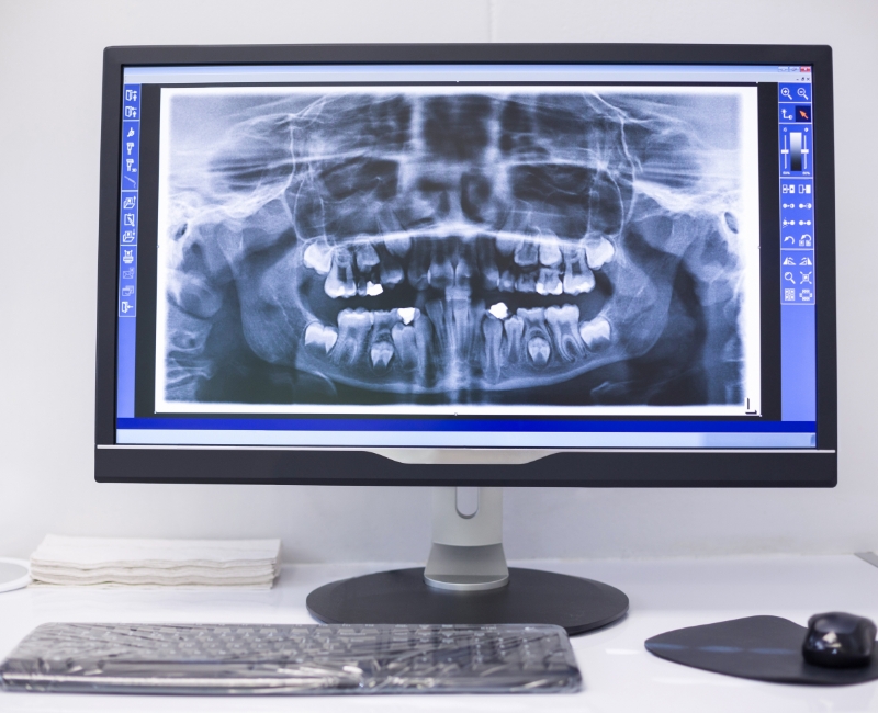 All digital dental x-rays
