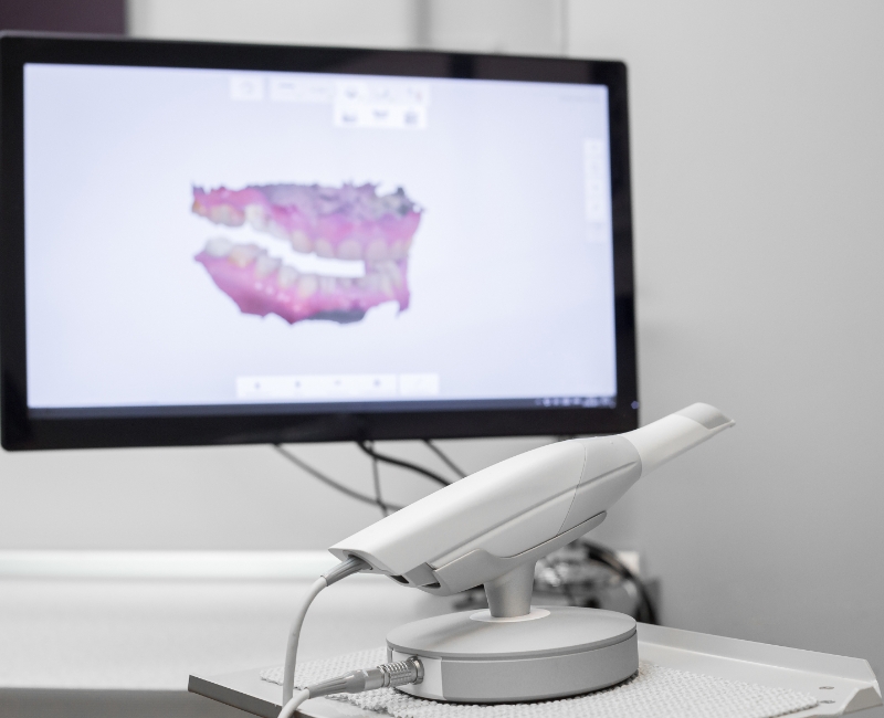 Digital dental impressions on chairside computer