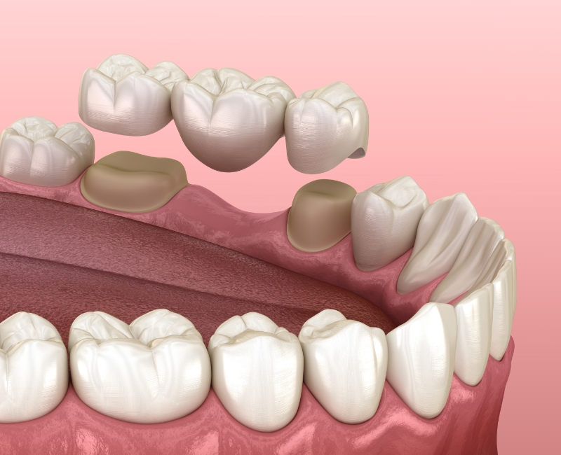 Animated smile during fixed bridge restoration placement