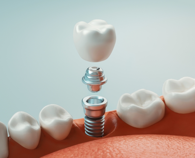 Animated smile during dental implant supported dental crown placement