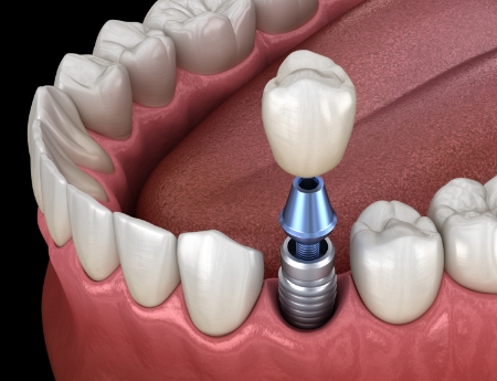 Animated smile during dental implant supported mental crown placement