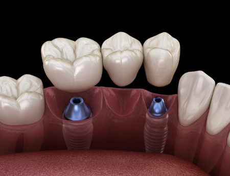 Animated smile during dental implant supported fixed bridge placement