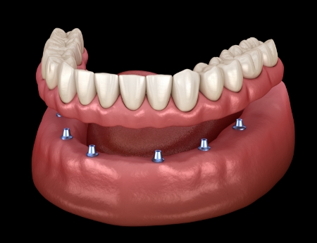 Animated smile during dental implant supported denture placement