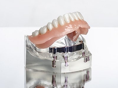 Model of implant-supported denture