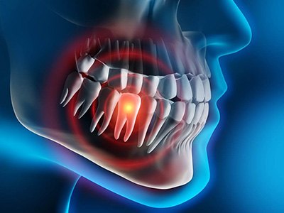 Digital model of a throbbing tooth