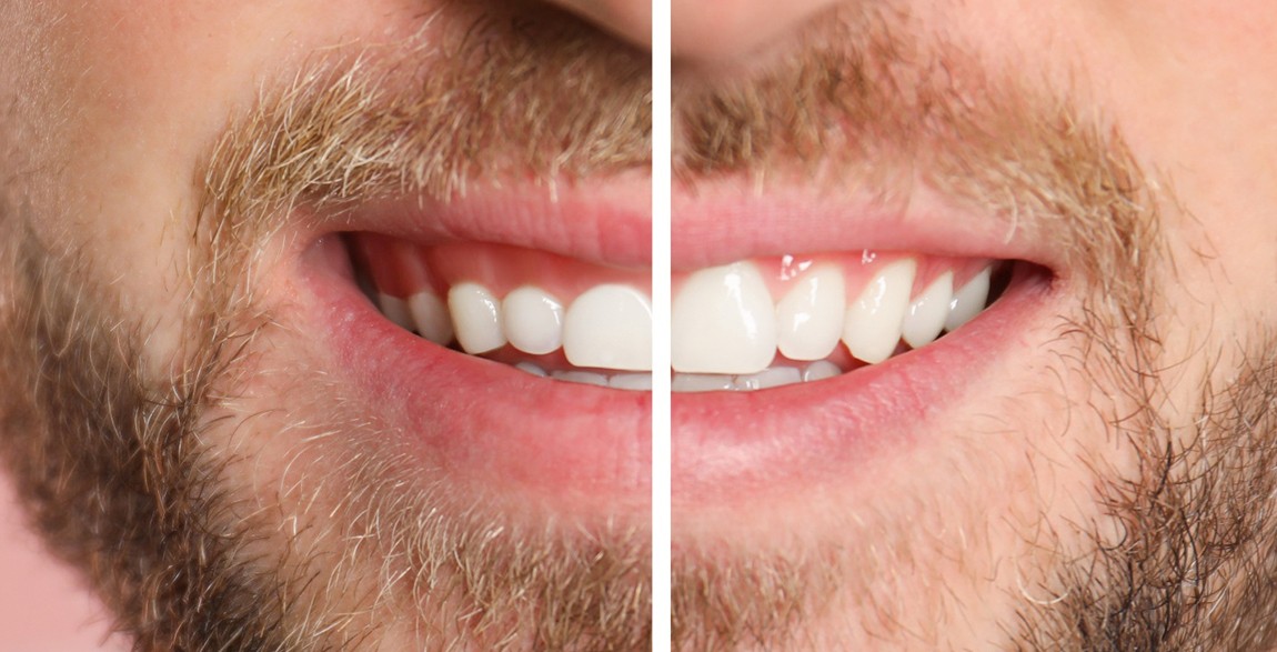 A man’s smile before and after gum recontouring
