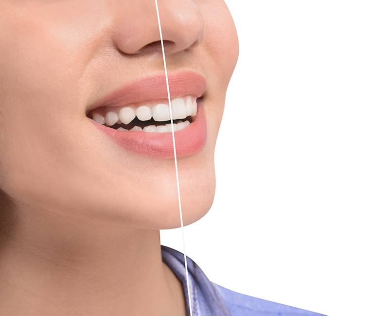 A woman’s smile before and after gum recontouring