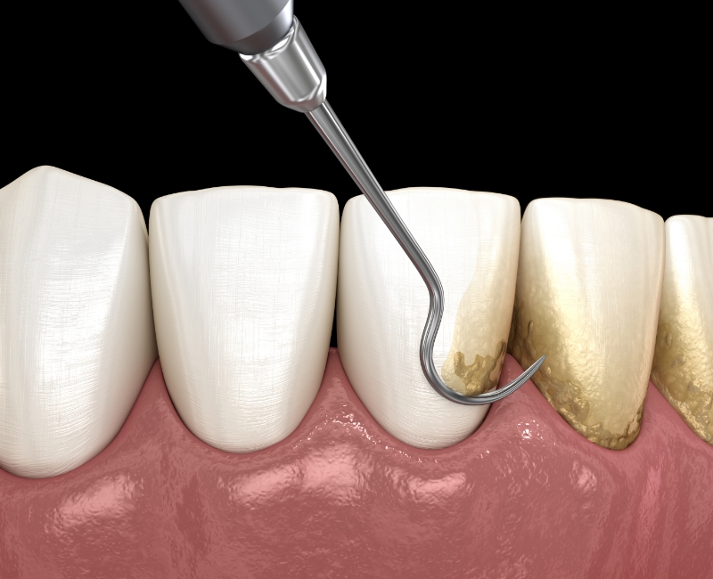 Animated smile during scaling and root planing treatment