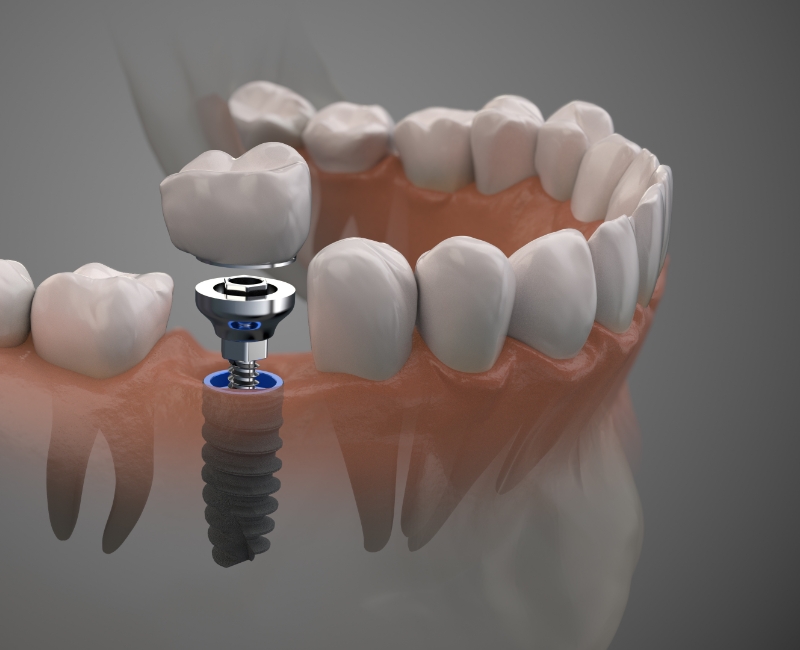 Animated smile during dental implant supported dental crown placement