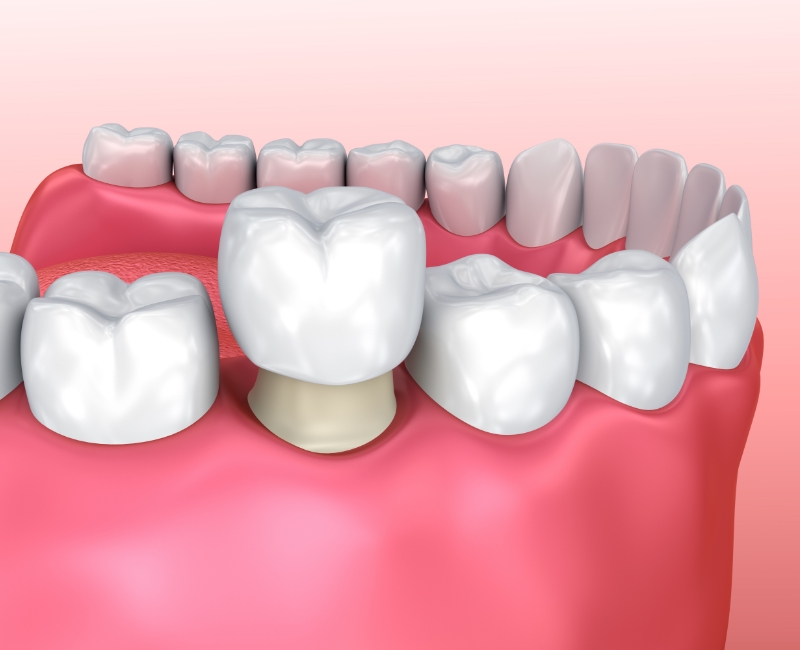 Animated smile during dental crown placement