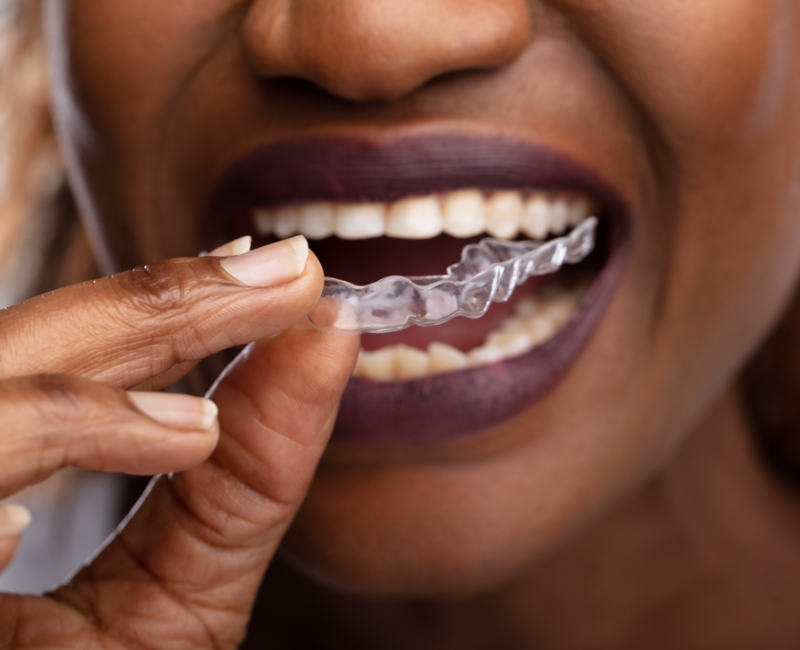 Closeup of patient placing ClearCorrect clear braces tray