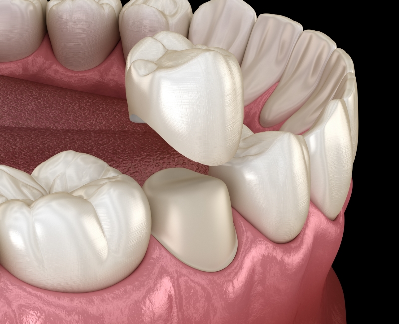 Animated smile during metal free dental crown placement