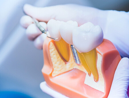 dentist working with model of dental implant in Rochester, MN