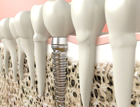 Illustration of a dental implant in Rochester, MN