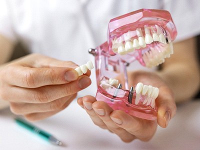 model of a mouth with dental implants