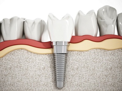diagram showing a dental implant in the jawbone