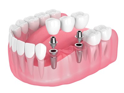 diagram of a dental bridge on top of dental implants
