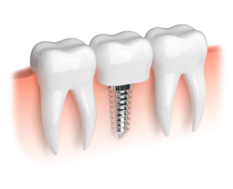 Illustration of a dental implant in Rochester, MN and crown