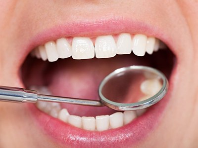 Close up of a dentist examining a patient’s teeth with dental mirror