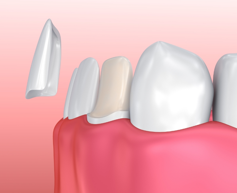 Animated smile during porcelain veneer placement