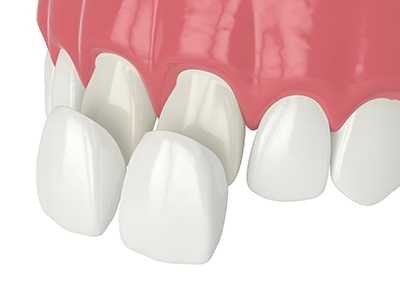 Illustration of two veneers in Rochester, MN