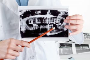dentist explaining x-ray using pencil