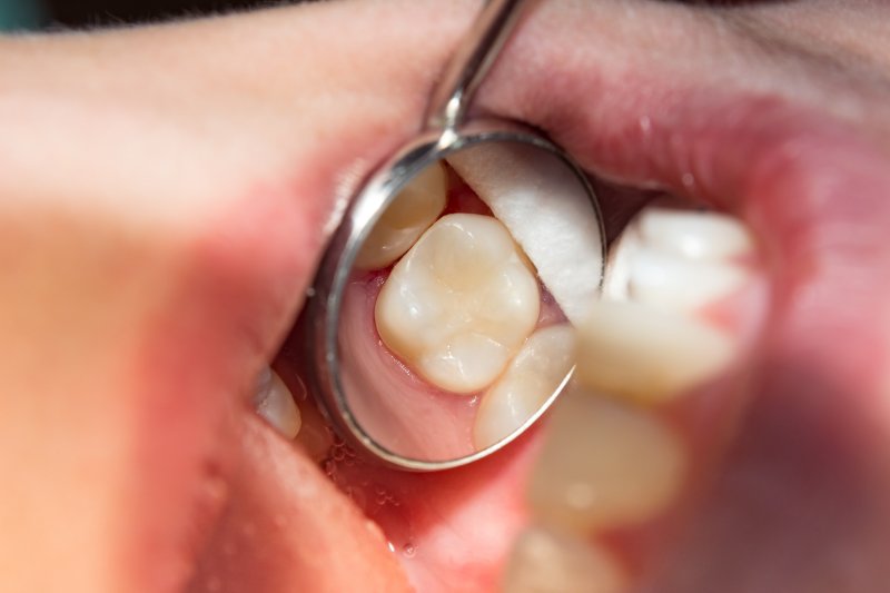 Tooth with dental filling