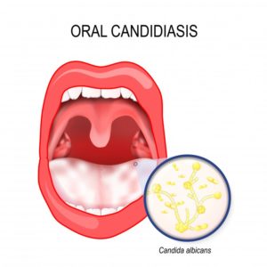 oral thrush on tongue 