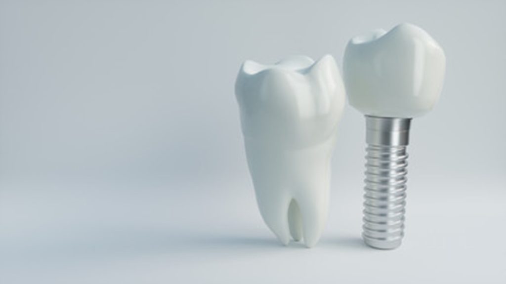 Dental implants.