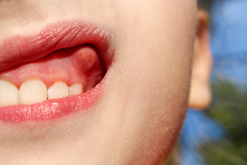 Child with bump on gums