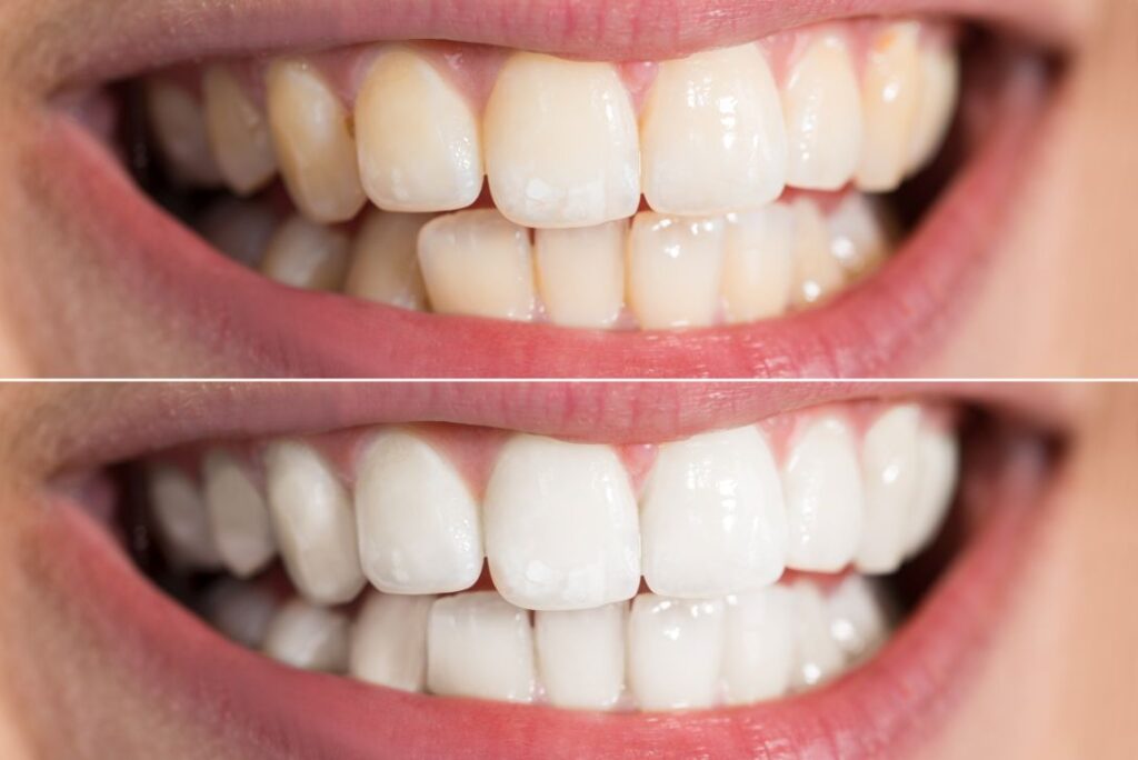 A before and after photo of a patient who had professional teeth whitening